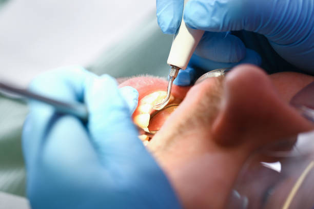 Best Emergency Tooth Extraction in Keuka Park, NY